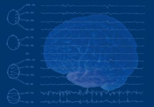 Brain Tumors and Epilepsy