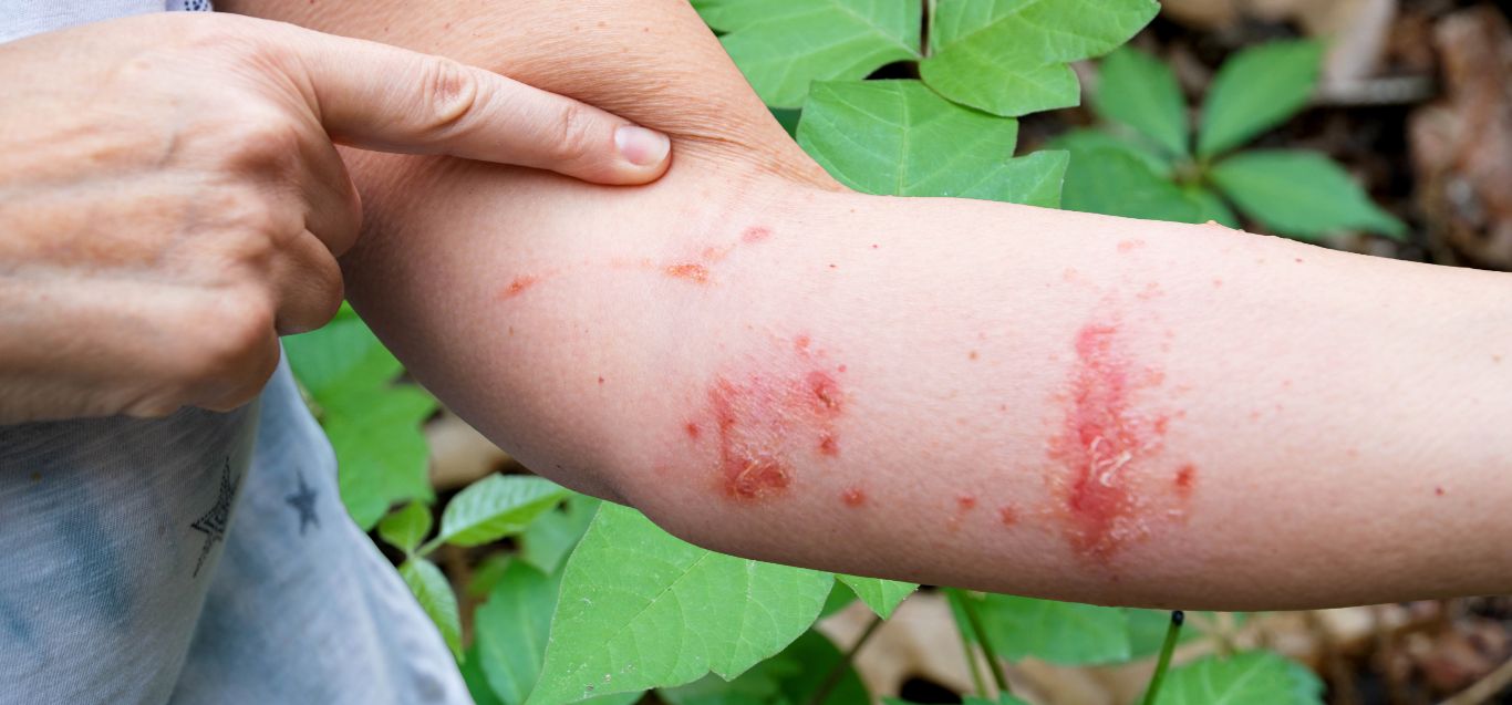Poison Ivy, Poison Oak and Poison Sumac: What Parents Need to Know