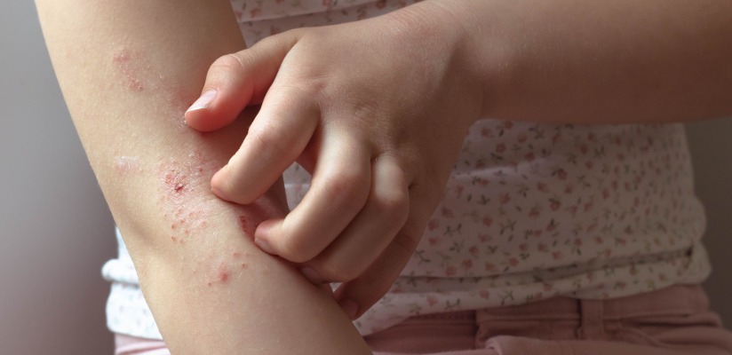 Eczema.jpeg